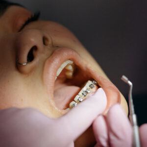 Braces in Reno and Sparks, NV